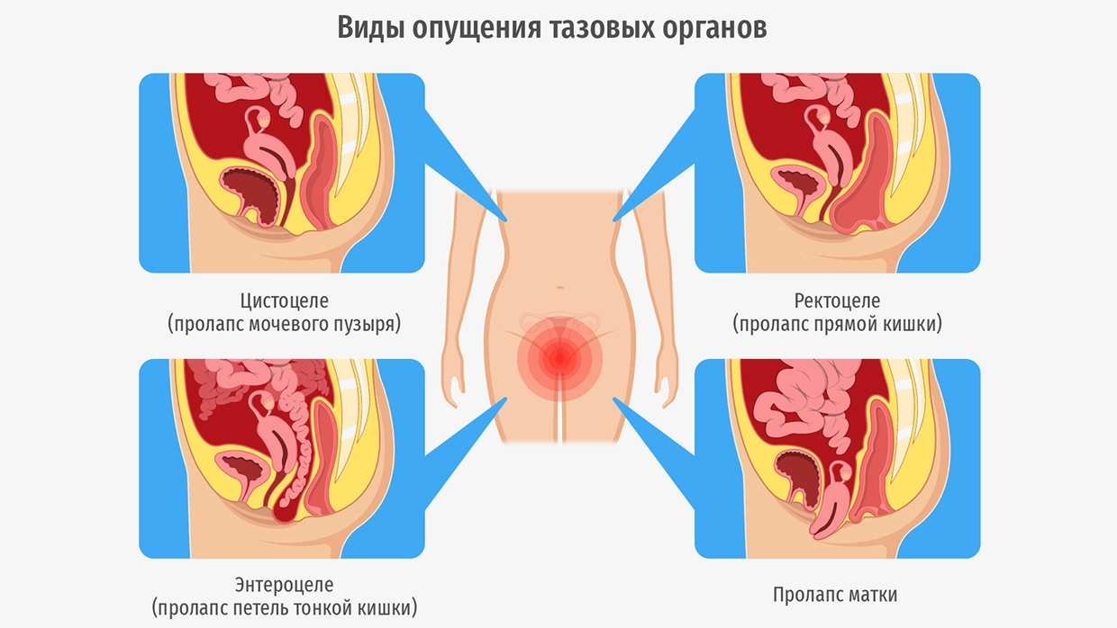 Опущение органов малого таза (пролапс тазовых органов)